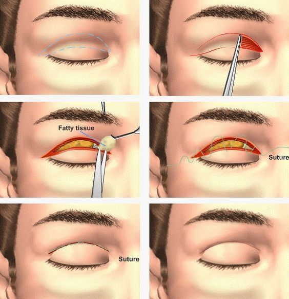 Blepharoplastik in der Türkei - Maxımed Istanbul 