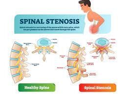 Spinalkanalstenose - Symptome, Risiken und Behandlung