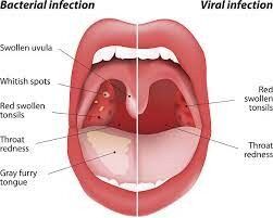 Pharyngitis - Symptome, Ursachen, Vorbeugung und Behandlung